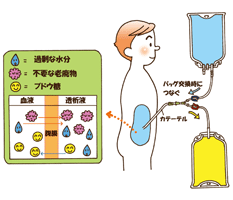 腹膜透析治療 図2